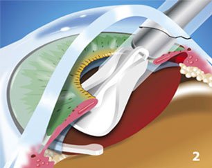 What Is Cataract What You Should Know About Cataracts