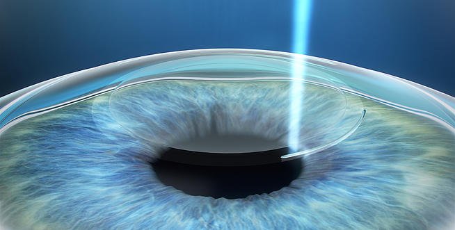 Relex Smile Teknologi Lasik Terbaru Dari Zeiss Tanpa Flap Klinik Mata