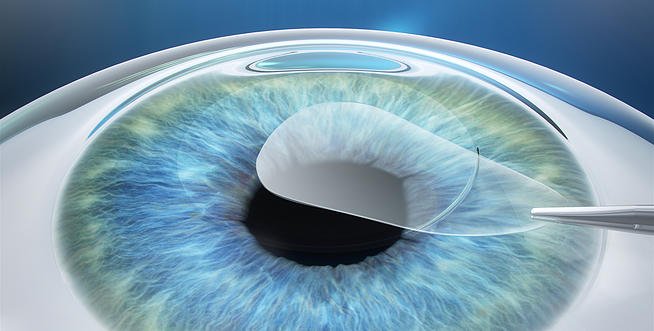 Relex Smile Teknologi Lasik Terbaru Dari Zeiss Tanpa Flap Klinik Mata