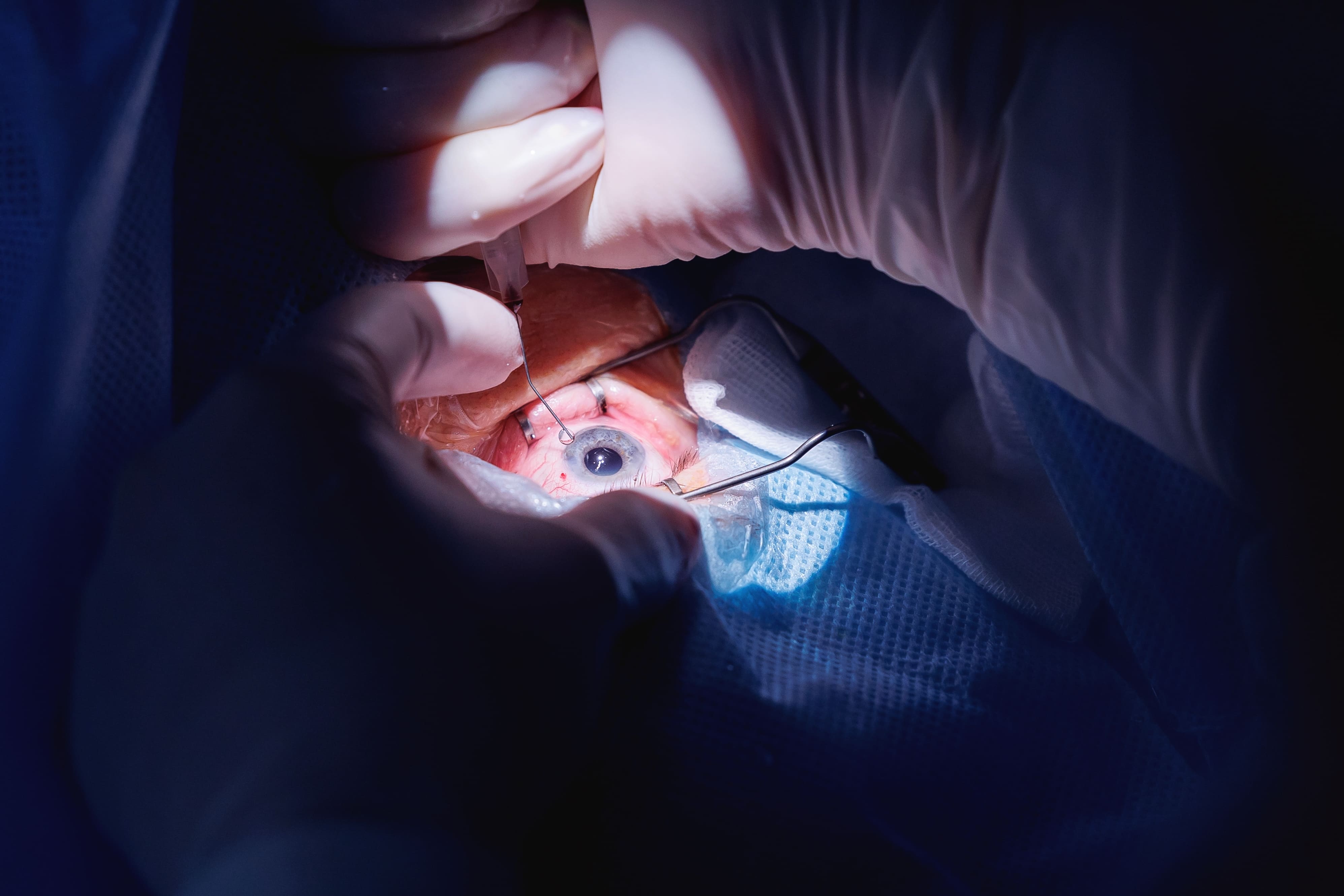 Mengenal Persamaan Lasik Mata dan Operasi Katarak